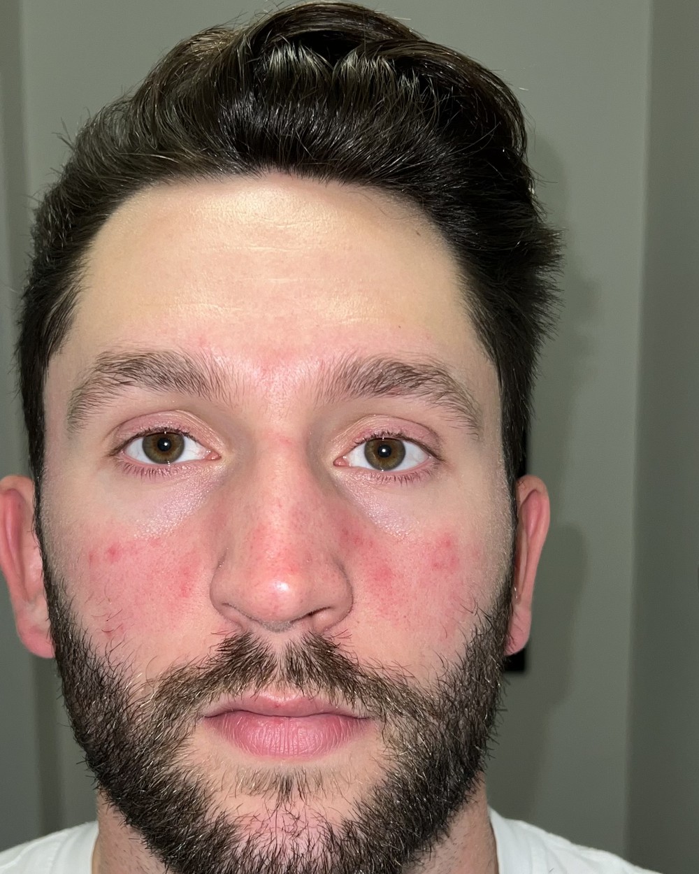 Kevin on day 1 of using Revival, with visible redness across his cheeks and nose.